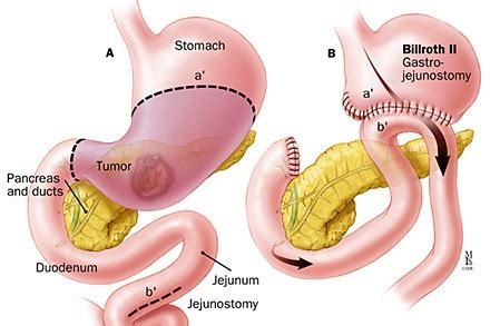 Fundraiser by Madison Kelly : Billroth II Procedure