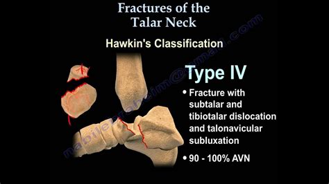 Talus fracture, Hawkin's Classificaiton - Everything You Need To Know - Dr. Nabil Ebraheim - YouTube