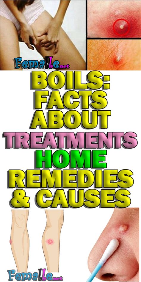 BOILS: Facts About Treatments, Home REMEDIES & CAUSES | Boils treatment ...