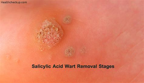 Stages Of Wart Removal Using Salicylic Acid By Dr. Ahmed