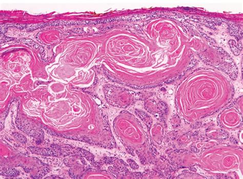 Squamous Cell Carcinoma (SCC) | Concise Medical Knowledge