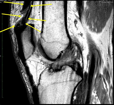 Ultrasound Imaging of Quadriceps Tendon in a Recreational Golfer ...