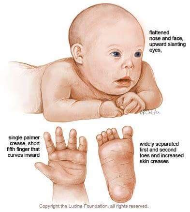 Trisomy 13 (Patau Syndrome): Symptoms, Causes Outlook, 48% OFF