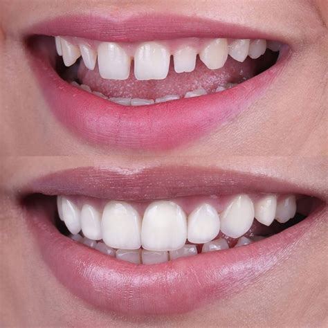 Veneers Turkey - £245 per Tooth - Special Techniques | MedAway