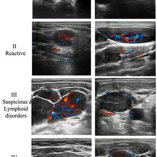 The ultrasound morphologic characteristics of cervical adenopathy ...