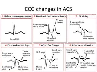 Ecg in acute coronary syndrome and acute care | PPT