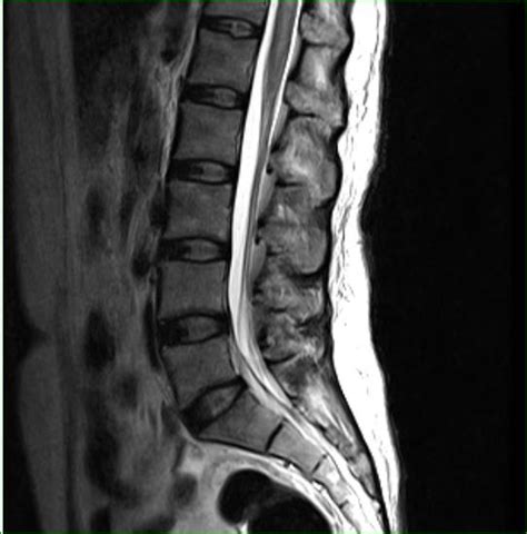 Tuberculosis Of Spine