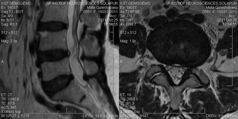 Dr Balaji Anvekar FRCR: Disc tear MRI Spine