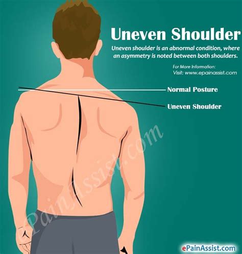 8 best Uneven shoulders images on Pinterest | Exercise, Better posture and Excercise