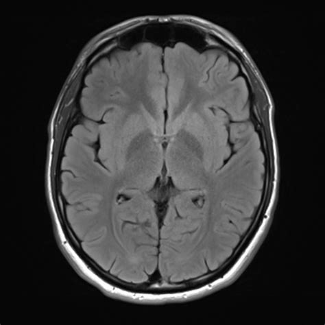 Normal Brain Mri