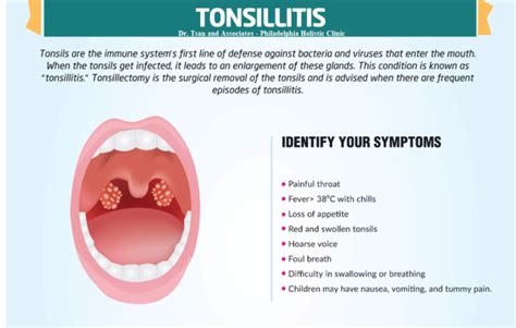 Treatment of Tonsillitis - Philadelphia Holistic Clinic - Dr. Tsan & Associates