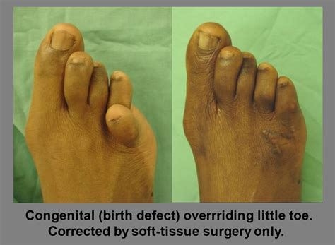 Toe Deformities