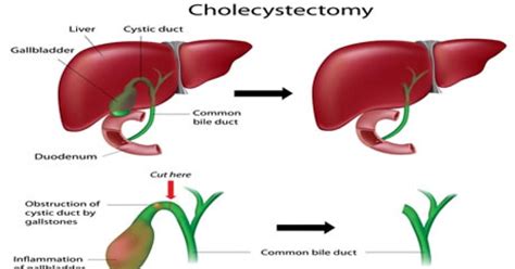 Cholécystectomie (ablation de la vésicule biliaire) : affections traitées, types d'intervention ...