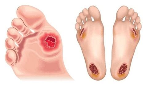 Diabetic Foot Infection - Causes and Treatment - VPS Lakeshore