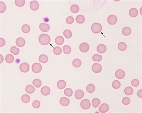 macrocyte – eClinpath