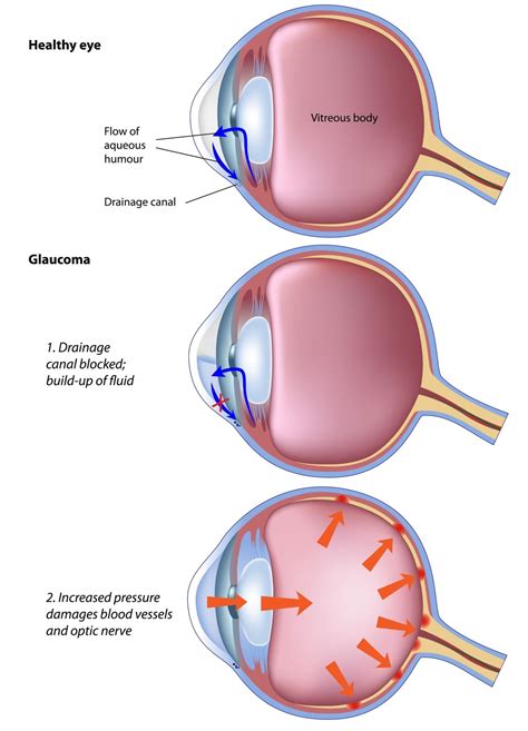 Glaucoma – Naveen Eye Hospital