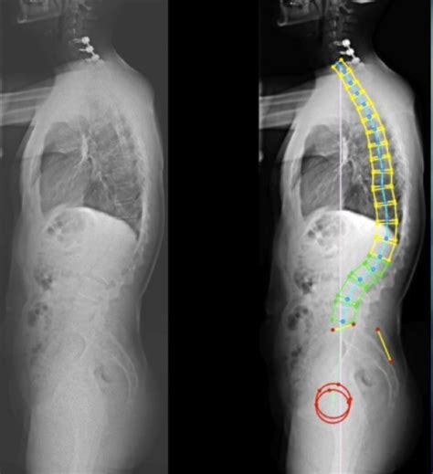 Pedicle Subtraction Osteotomy for Correction of a Rigid Lumbar Sagittal Plane Deformity - cns.org