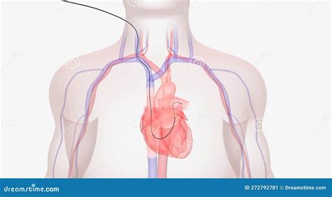 The In Heart Catheterization Through The Radial Artery, The Cath Stock Image | CartoonDealer.com ...