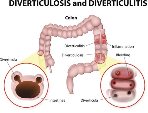 New irritable bowel syndrome (IBS) symptoms seen after acute bout of ...