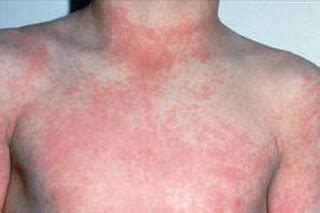 Scarlatina Rash Pictures | Medical Pictures and Images - (2018 Updated)