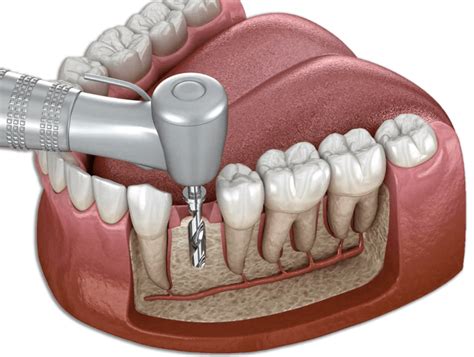 Los Algodones Dental Implants by Dr. Jose Moguel