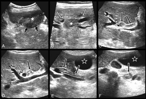 Six selected views of the right upper quadrant ultrasound illustrate... | Download Scientific ...