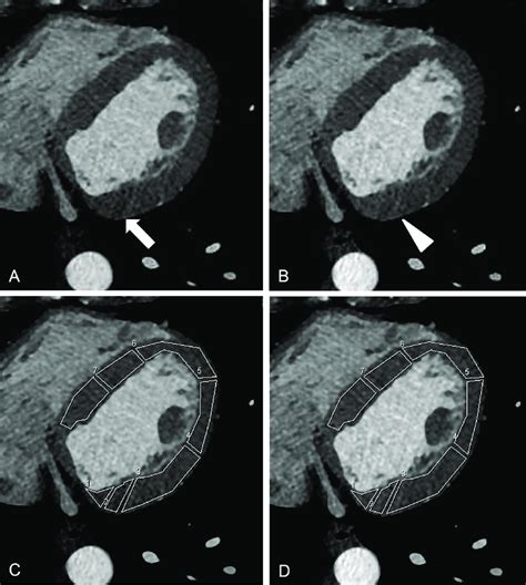 Beam-hardening artifact and ROI measurements performed. A streak-like... | Download Scientific ...