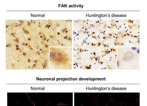 Exploring the causes of brain dysfunction in patients with Huntington's ...