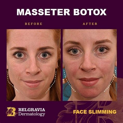 Masseter Botox Injection Technique