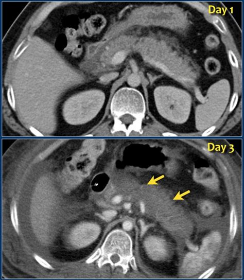 Hemorrhagic Pancreatitis Ultrasound