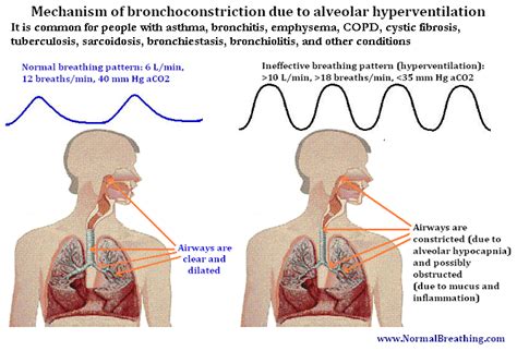 Bronchoconstriction Causes and Natural CO 2 -Based Treatment