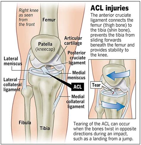 A Patient's Guide to Anterior Cruciate Ligament Injuries | Orthopaedic ...