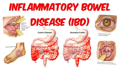 IBS大腸激躁症候群/IBD發炎性腸道疾病 傻傻分不清楚!?