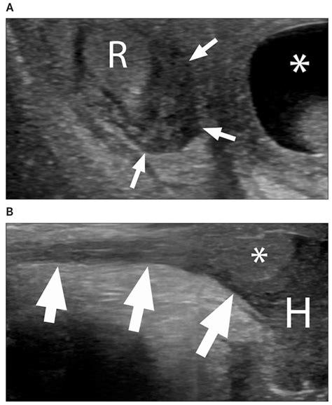 Scrotal hematoma. A, Transverse grayscale sonogram of the right... | Download Scientific Diagram