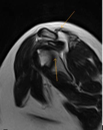 Os Acromiale with Impingement-MRI - Sumer's Radiology Blog