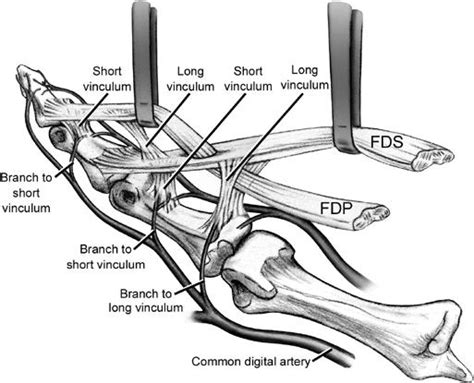 Flexor Tendon Injuries - Hand - Orthobullets