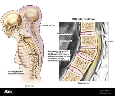 Thoracic vertebra 11 fotografías e imágenes de alta resolución - Alamy