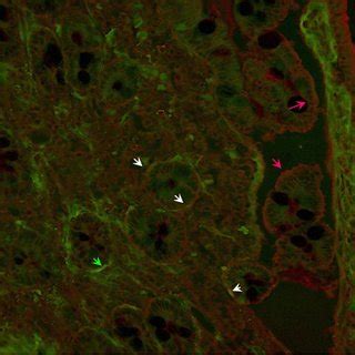 Photomicrograph showing an intense positivity for anti-endomysial ...