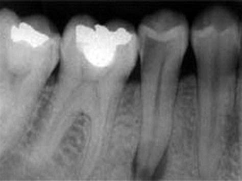 Dental Caries Radiograph