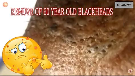 REMOVE OF 60 YEAR OLD BLACKHEADS!!!Part1 - YouTube