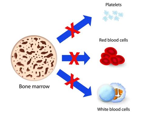 Aplastic anemia