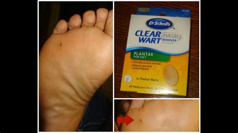 Dr Scholl S Plantar Wart Removal Freeze Away | Bruin Blog