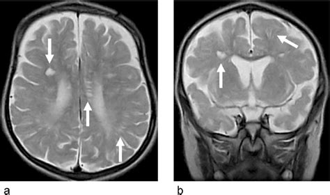 Dilated perivascular space in mucopolysaccharidoses. a T2-WI (axial), b ...