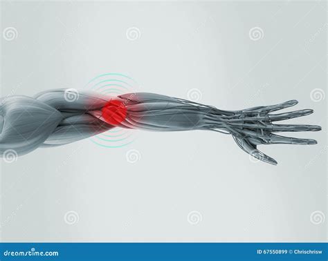 Anatomy Model Showing Elbow Pain. Stock Illustration - Illustration of ...