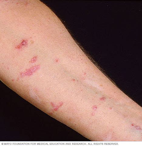 Lichen planus Disease Reference Guide - Drugs.com