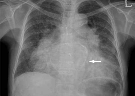 The posteroanterior view of chest X-ray illustrating di | Open-i