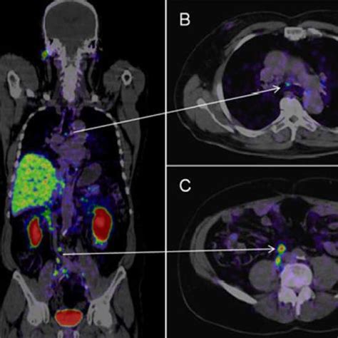 PSMA PET Scan - Purpose, Preparation & Complete Procedure