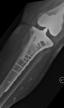 Periprosthetic Fracture Treatment in Total Knee Replacement | Musculoskeletal Key