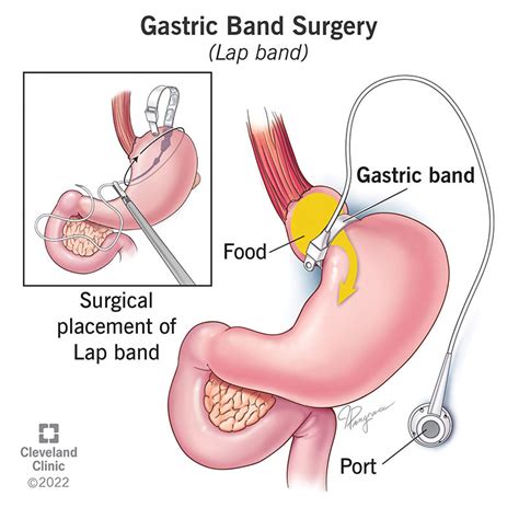 Gastric Band Surgery (LAP-Band): What It Is, Requirements & Procedure