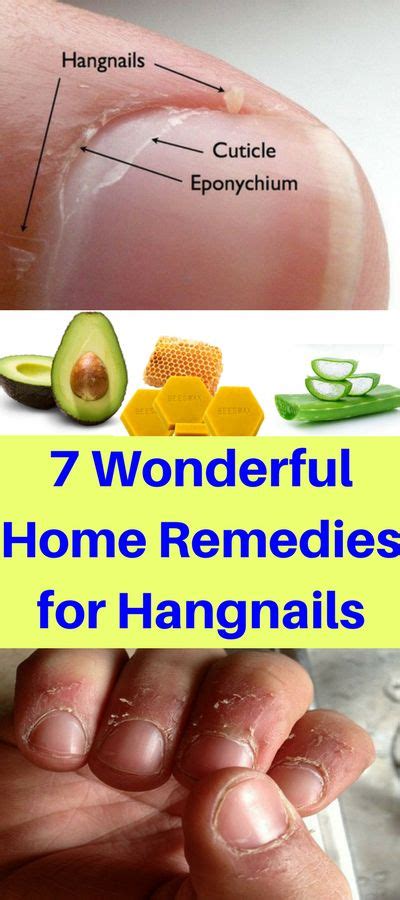 7 Wonderful Home Remedies for Hangnails – OBSOLO | Home remedies, Remedies, Health and beauty